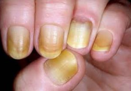 El síndrome de uñas amarillas (YNS)